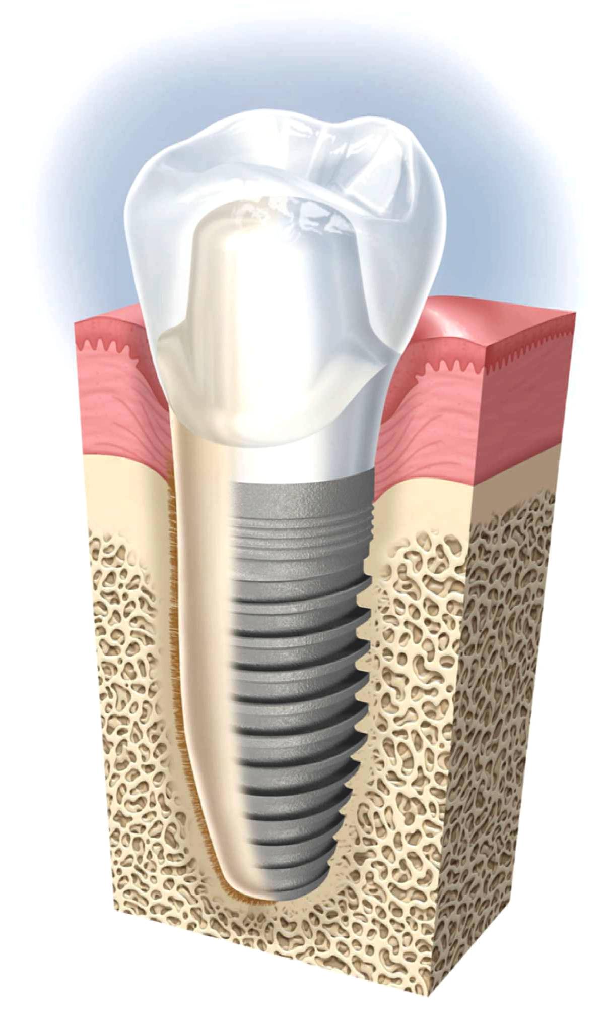 implante dental fig 2